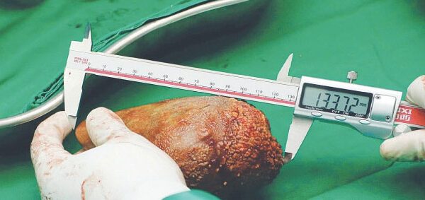 Remarkable Achievemen Sri Lankan Medical Team Extracts the Largest Kidney Stone on Record